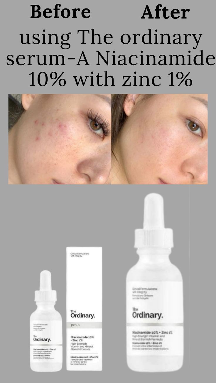 Niacinamide 10% + Zinc 1% (The Ordinary)
